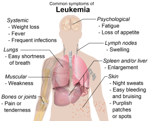 dexamethasone acute lymphoblastic leukemia