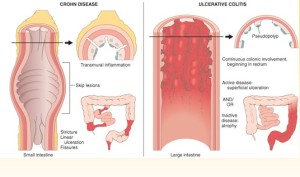 dexamethasone for ulcerative colitis