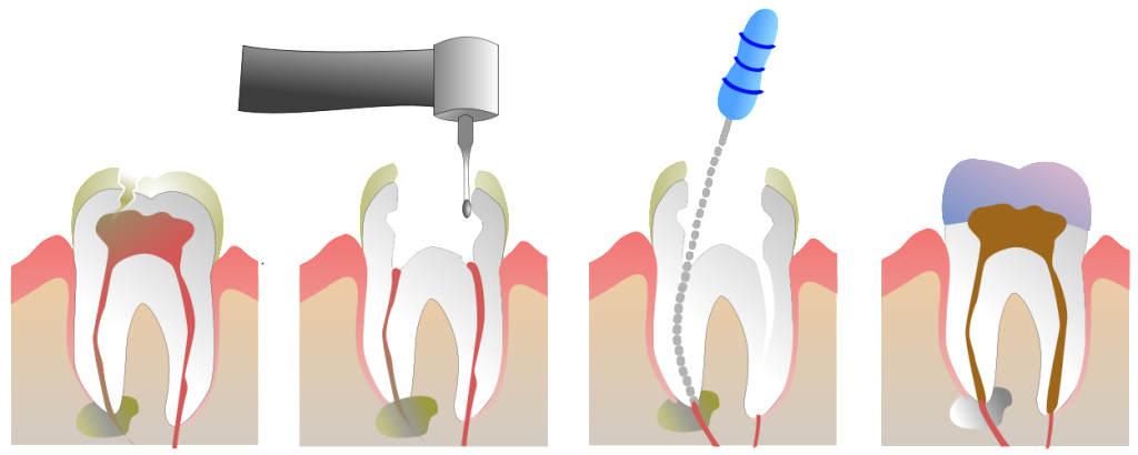 Dexamethasone for root canal